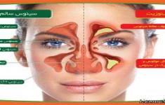 مسابقه اطلاعات پزشکی سینوزیت